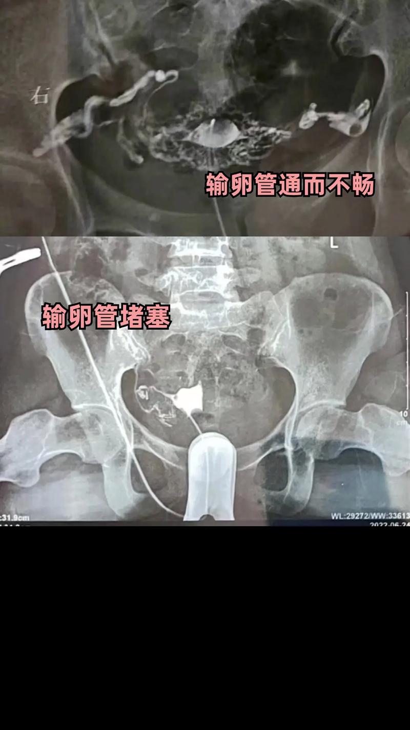  输卵管问题