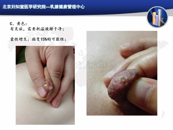 乳房溢液