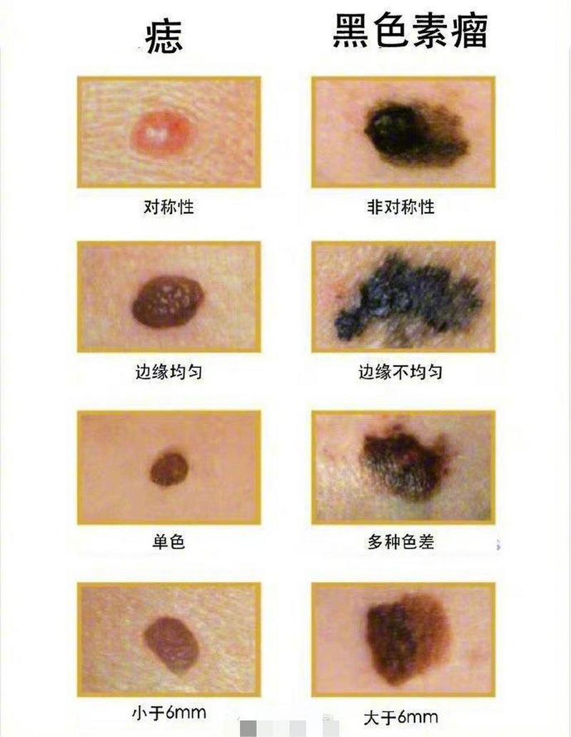  色素痣