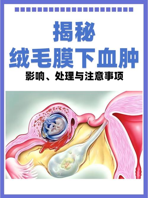 绒毛膜血肿