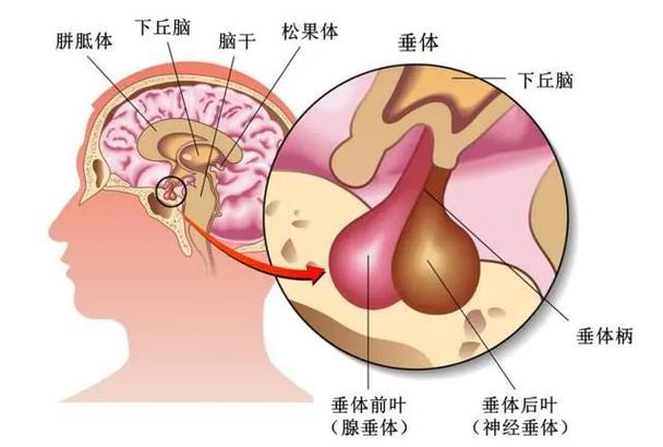 垂体瘤