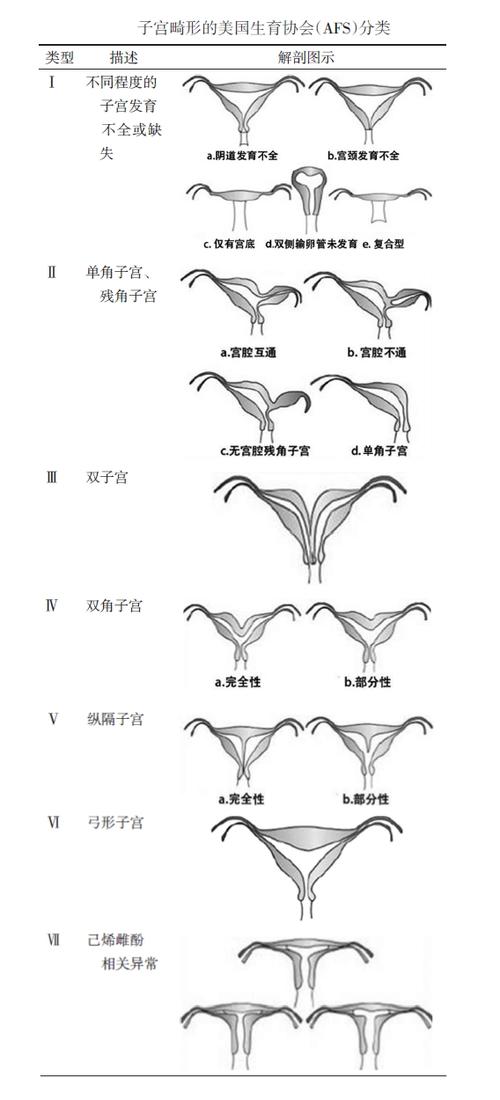 子宫类型
