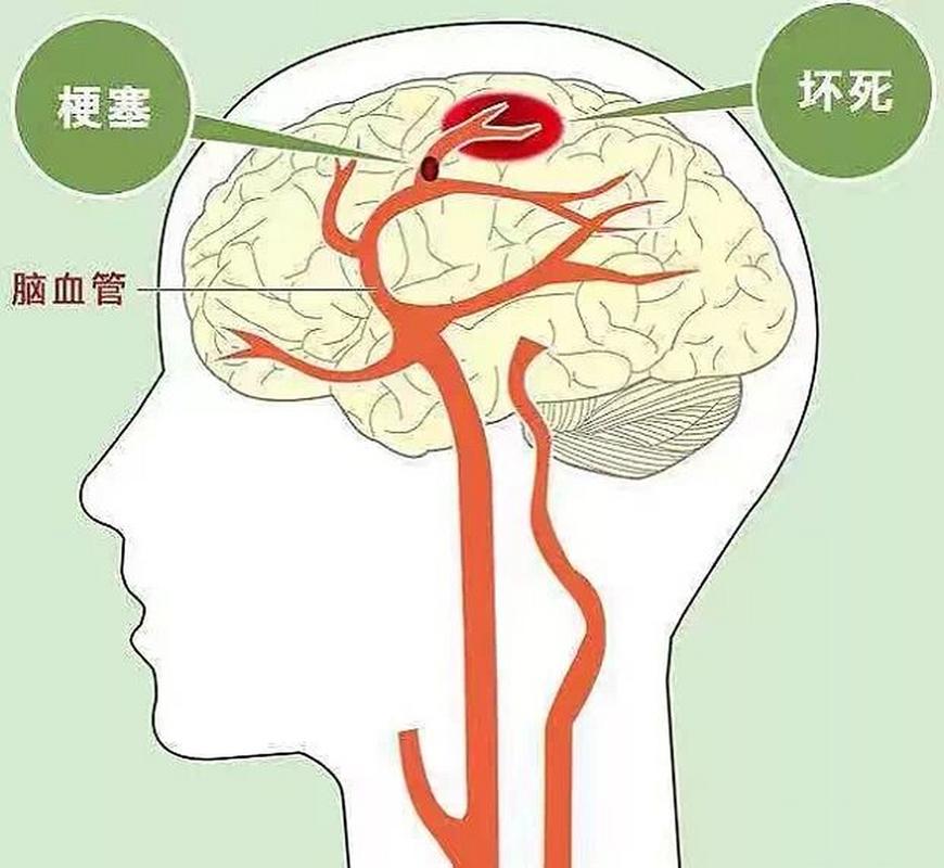 脑梗死