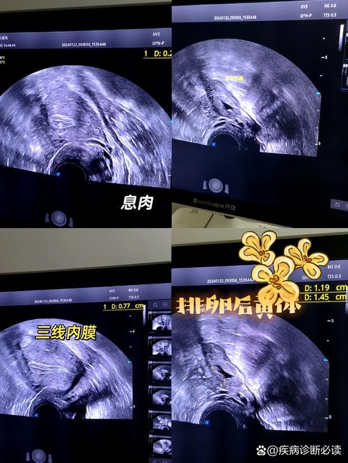 妇科超声