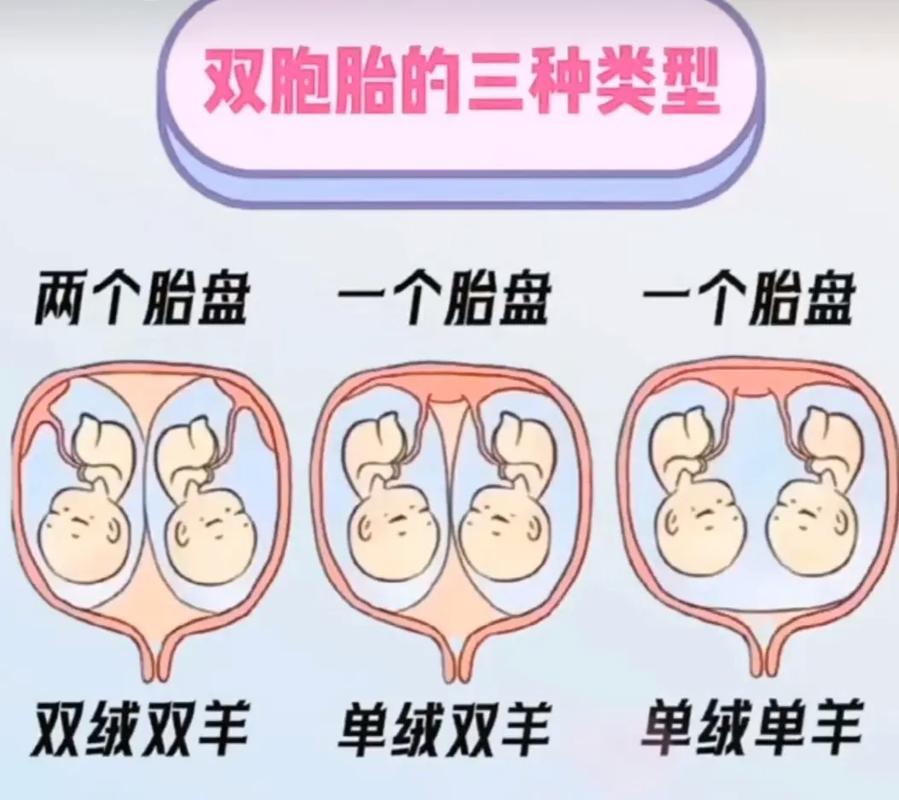 自然怀孕双胎对比