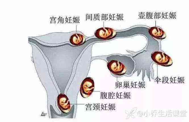 囊胚宫角妊娠