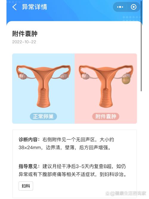 附件囊肿