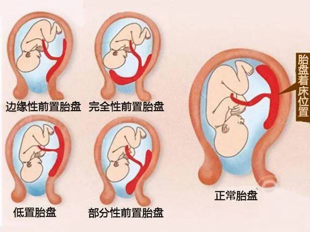 中央前置胎盘