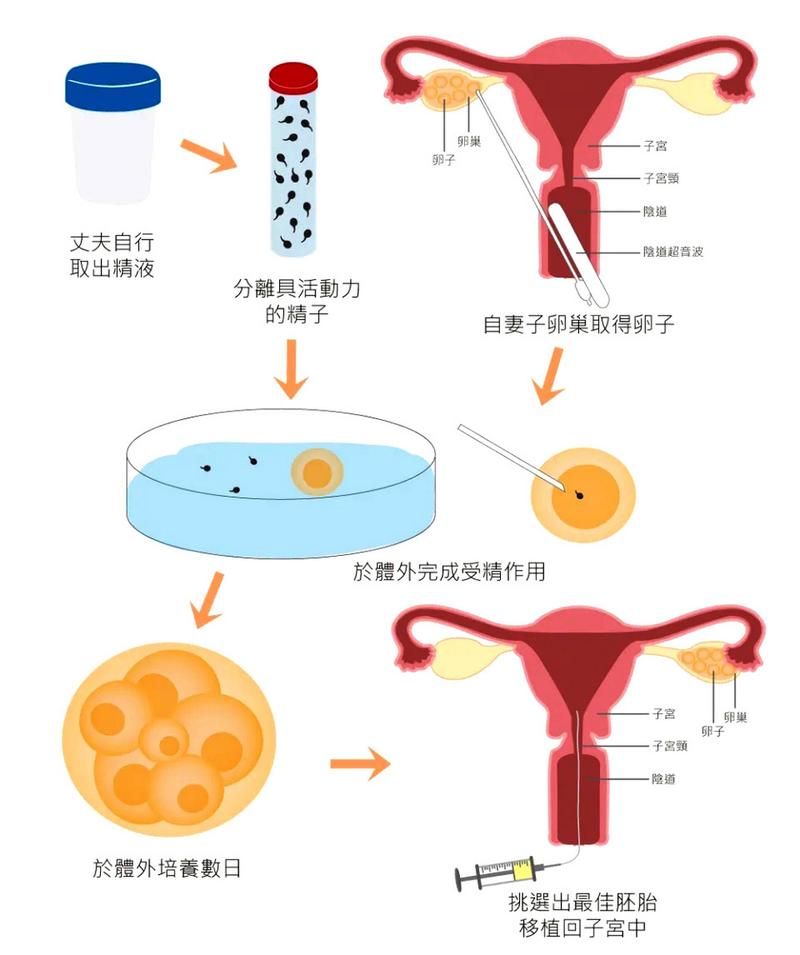 第二代试管婴儿技术