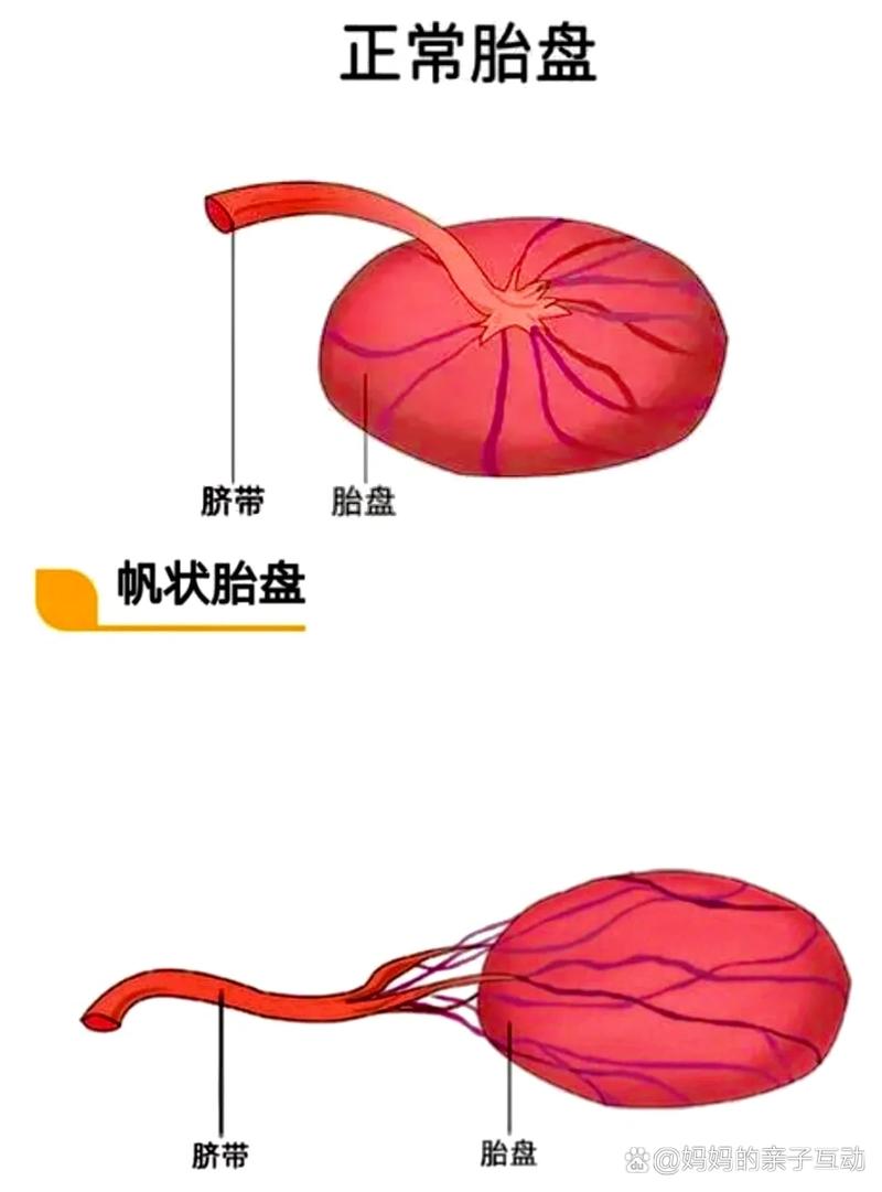 帆状胎盘