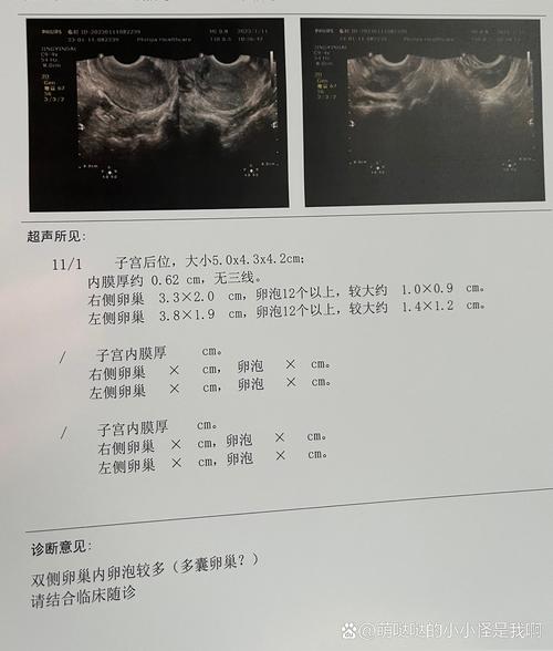  卵巢监测