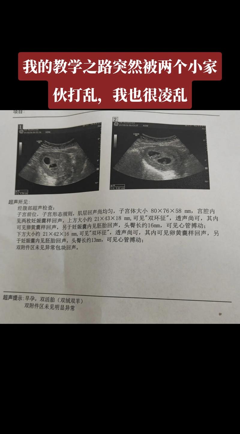  多胞胎记录