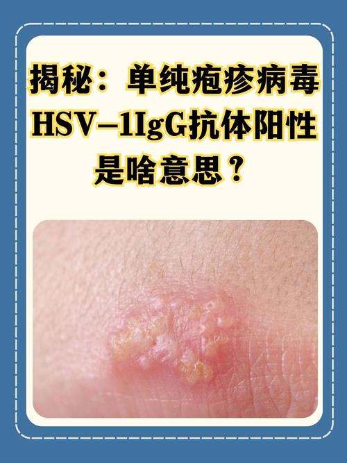 单纯性疱疹
