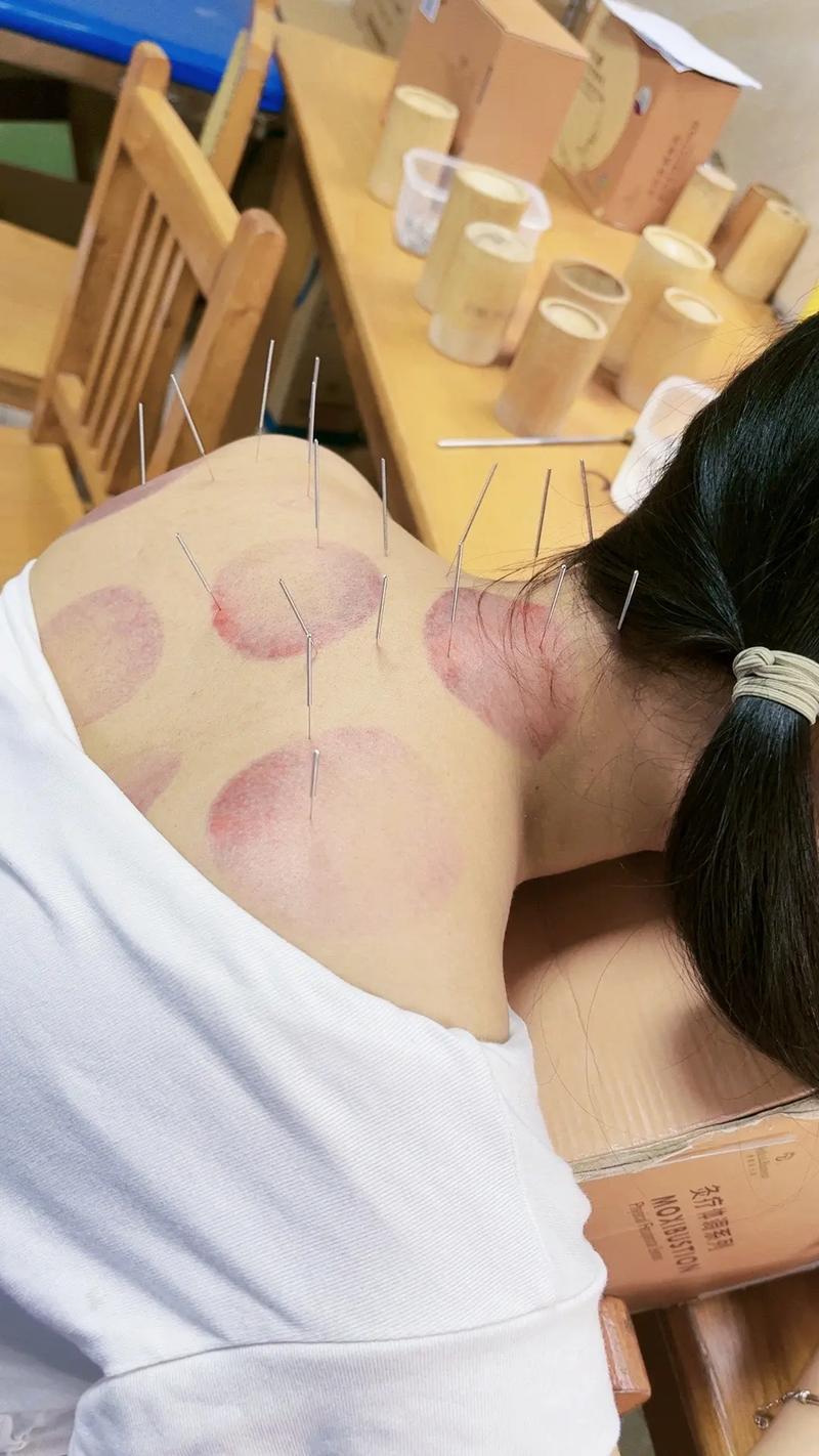 扎针经历