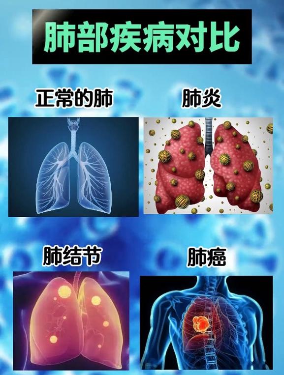  肺部疾病
