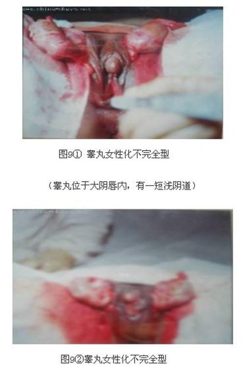 男方畸形