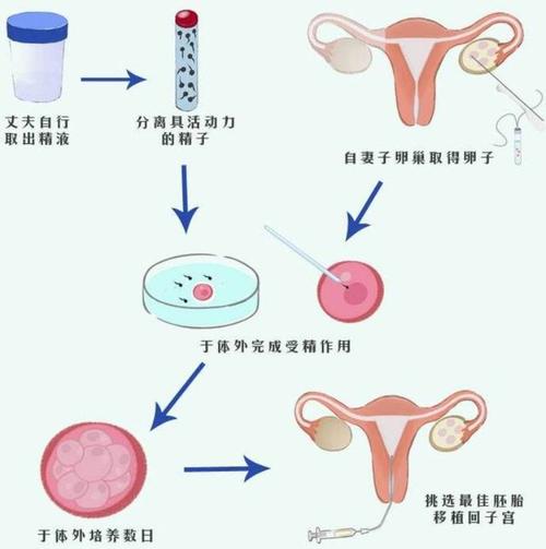 试管婴儿生育过程
