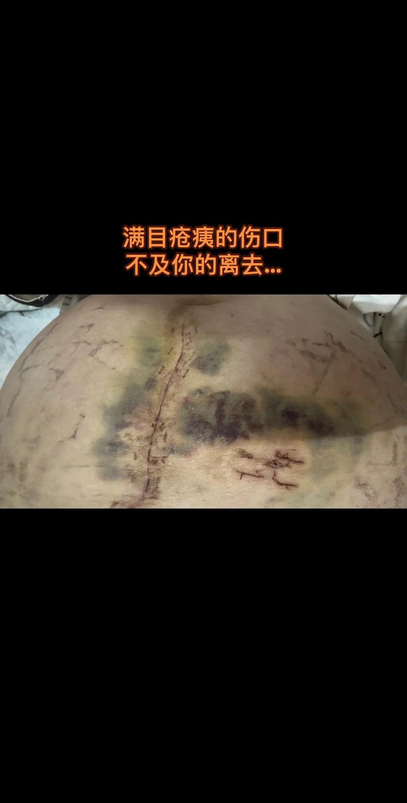 妊娠期并发症