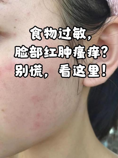 食物过敏
