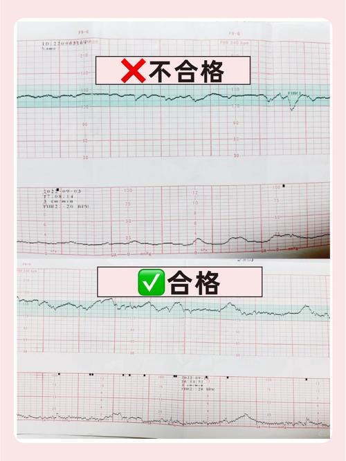 早期胎心监测