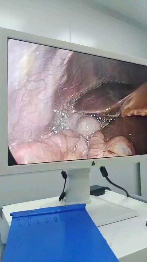 肚子积水