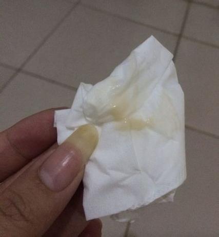 异常分泌物