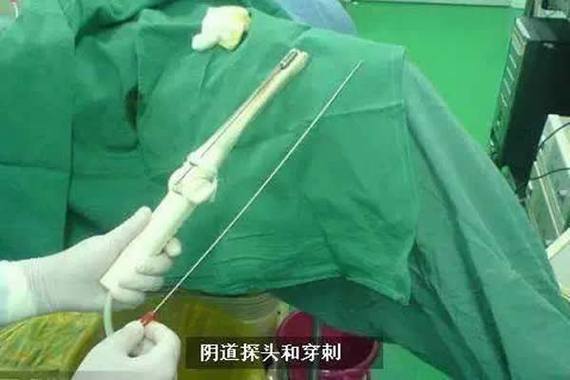 成功取卵
