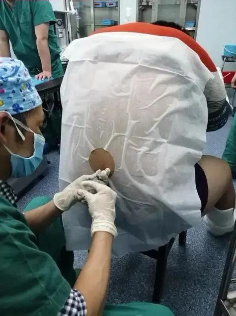 麻醉分娩