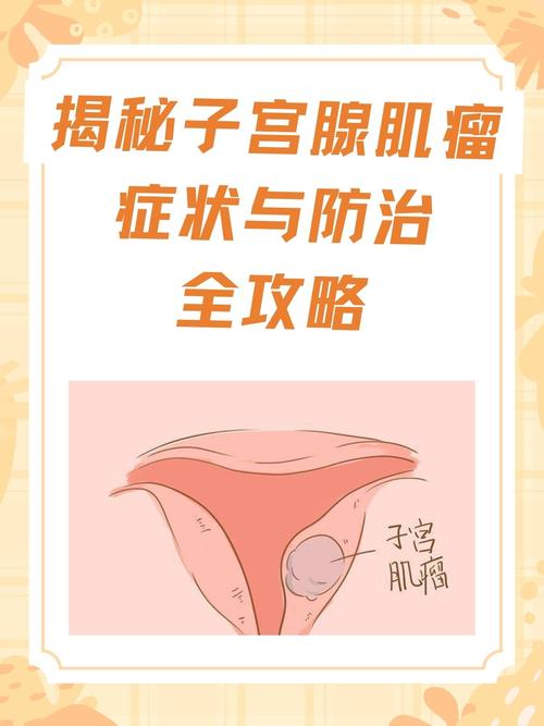 腺肌瘤