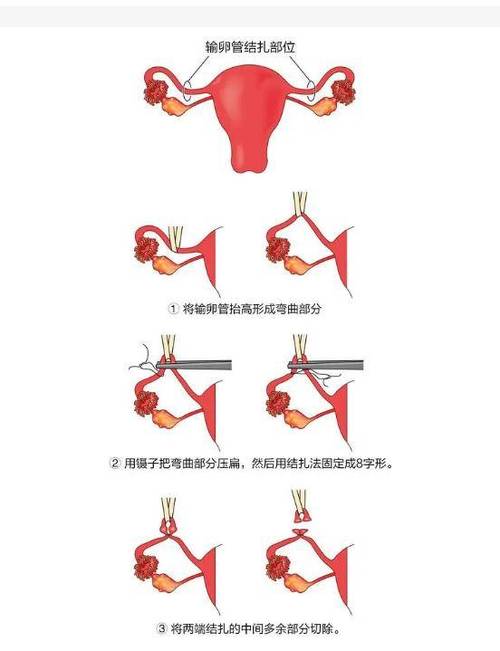  输卵管结扎