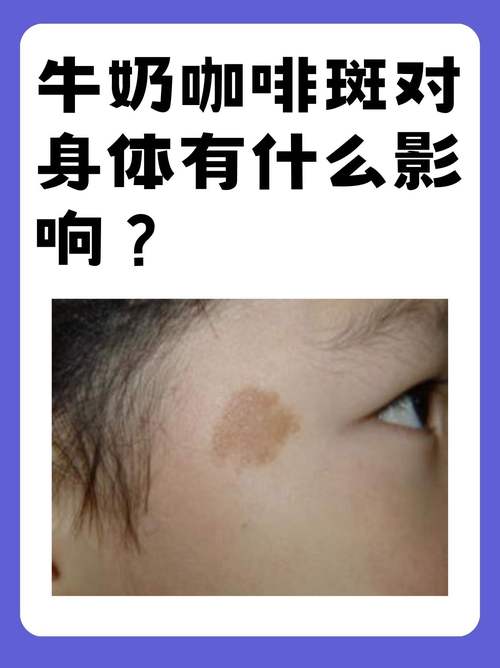 牛奶咖啡斑