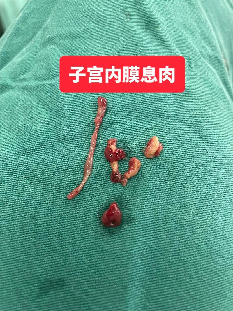 宫颈息肉