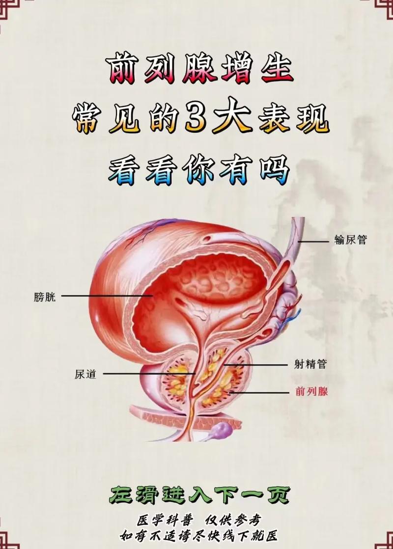 前列腺增生