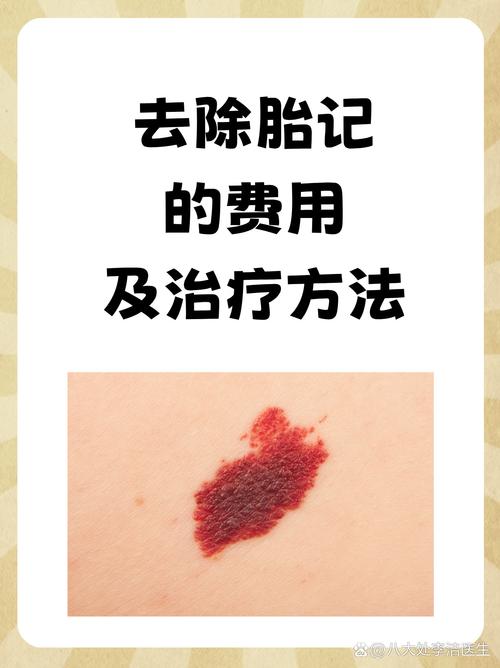 胎记去除