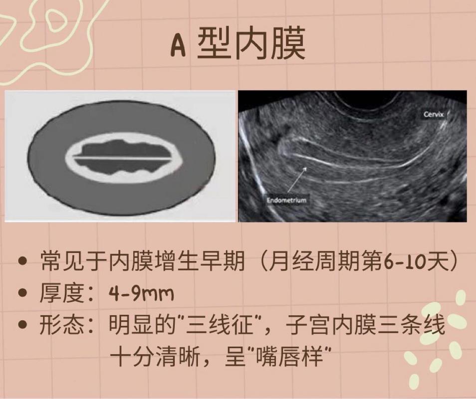 内膜形态