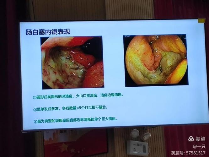 肠白塞病