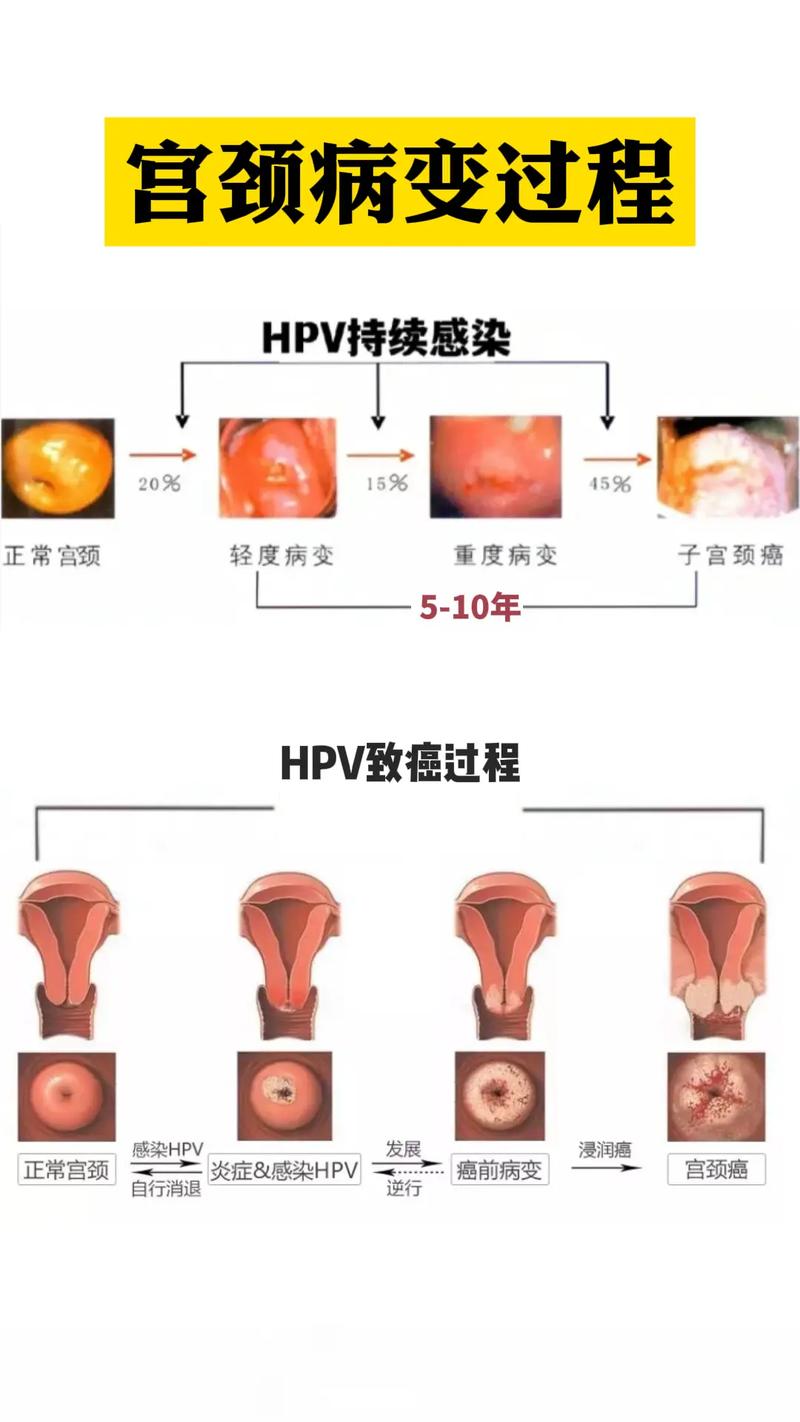子宫病变