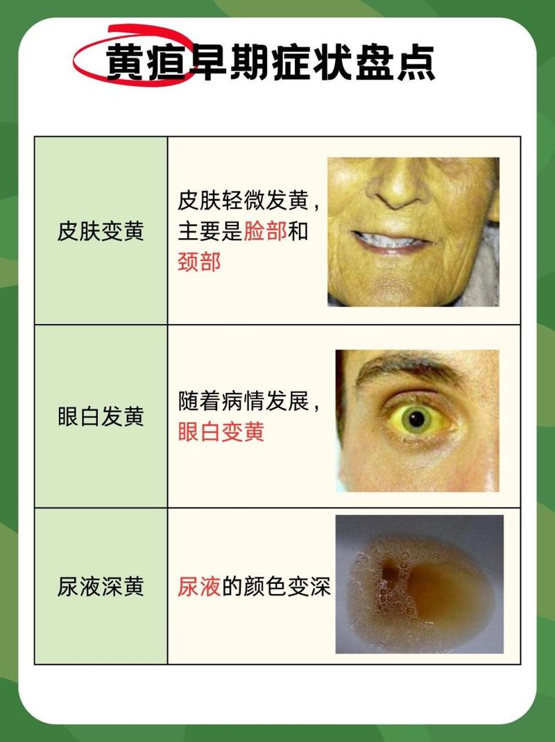 黄疸症状