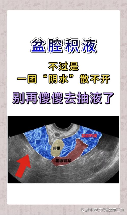 盆腔积液