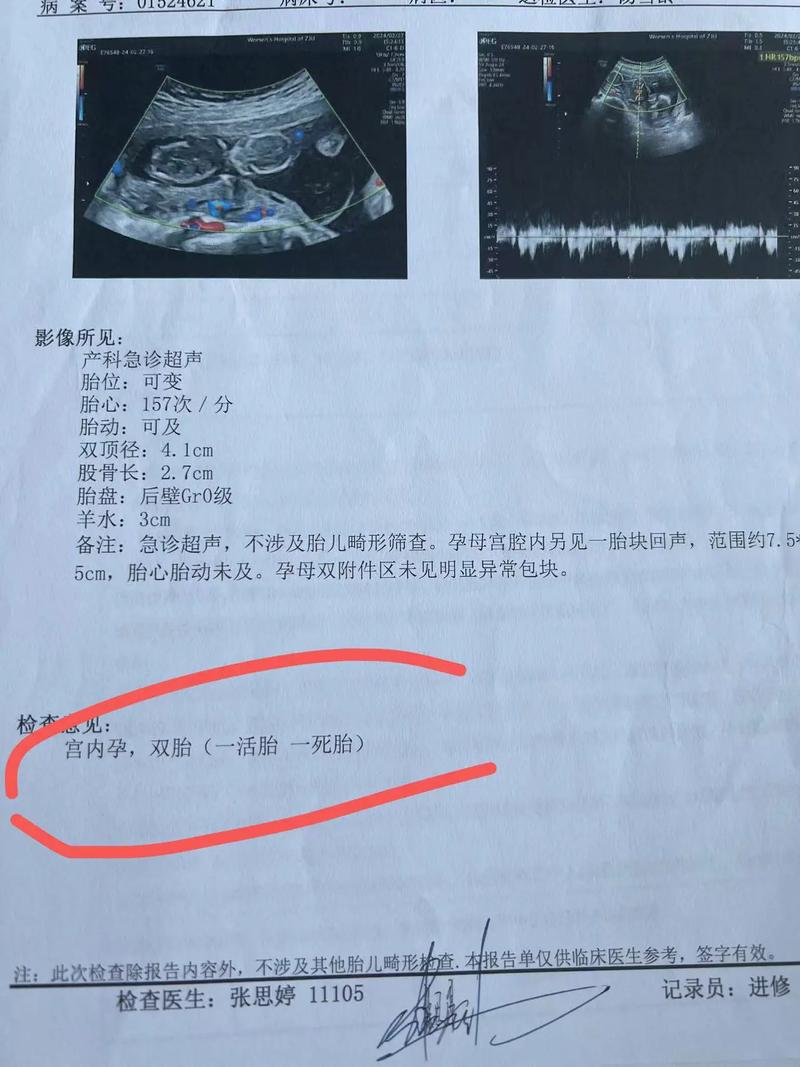 无胎心