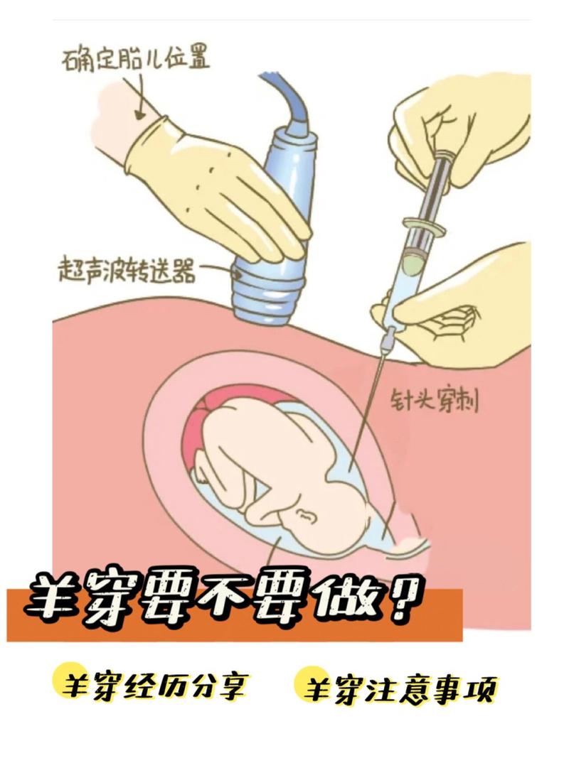 羊水穿刺