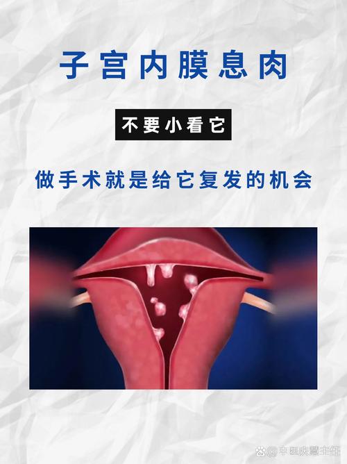 子宫内膜息肉