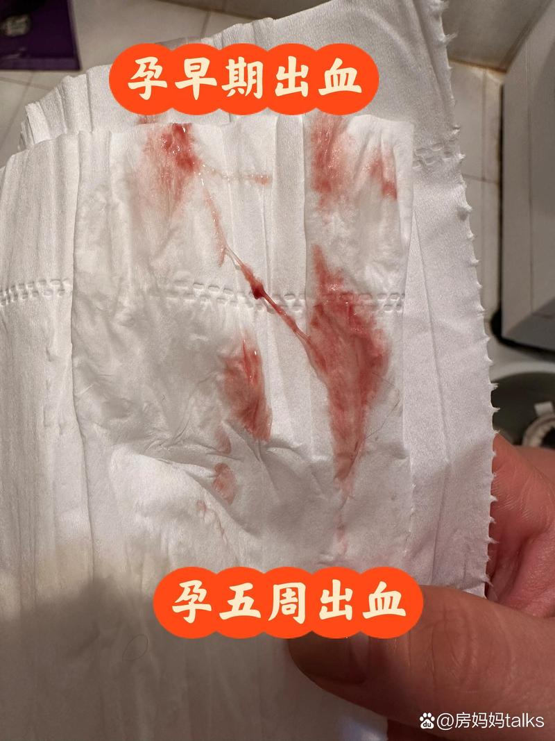 孕中期大出血