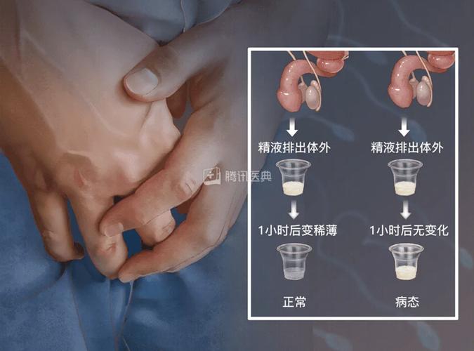 取精术