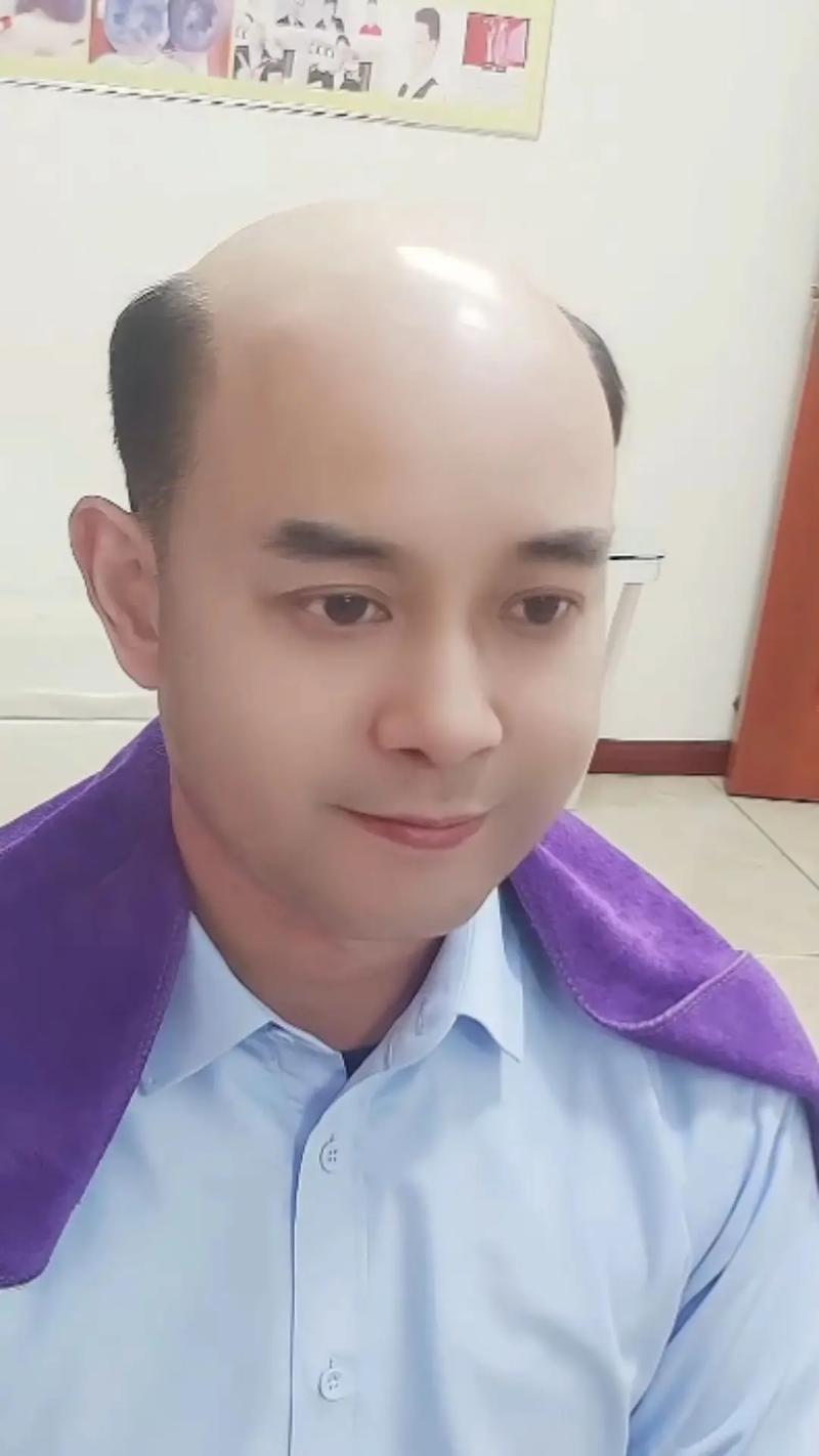 秃顶男性