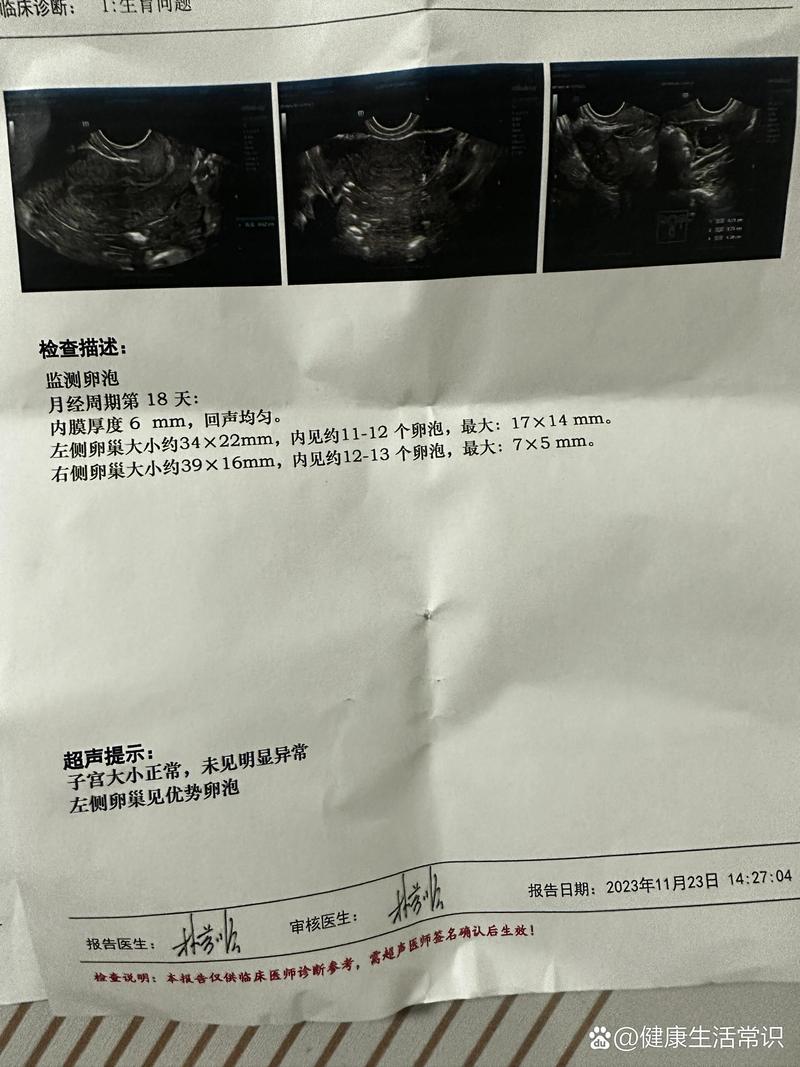 卵泡小